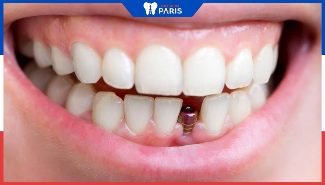 Địa chỉ trồng răng implant tại Thanh Hóa tốt nhất – Nha khoa Paris