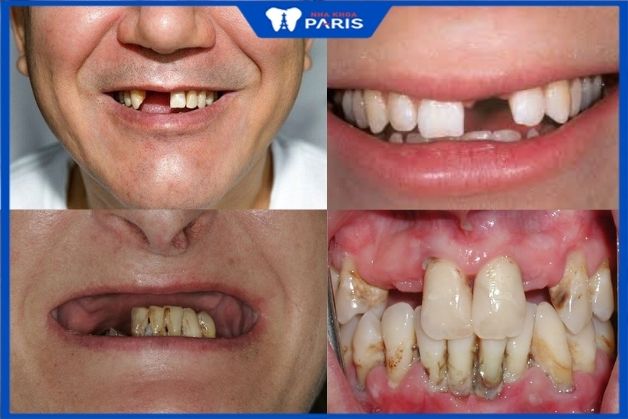 Trụ Implant Dentium Mỹ áp dụng được với nhiều trường hợp mất răng