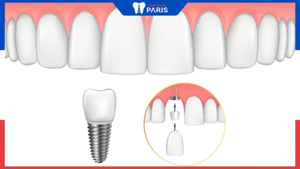 5 tiêu chí chọn trụ răng implant tốt nhất định phải biết