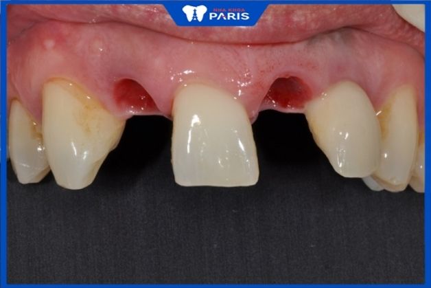 Trụ răng implant giúp khách hàng ngăn ngừa biến chứng mất răng