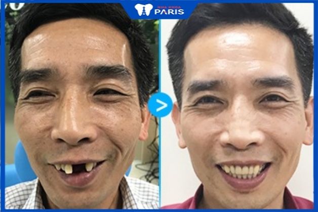 Khách hàng cao tuổi trồng răng tại nha khoa Paris Bệnh tiểu đường có trồng implant được không