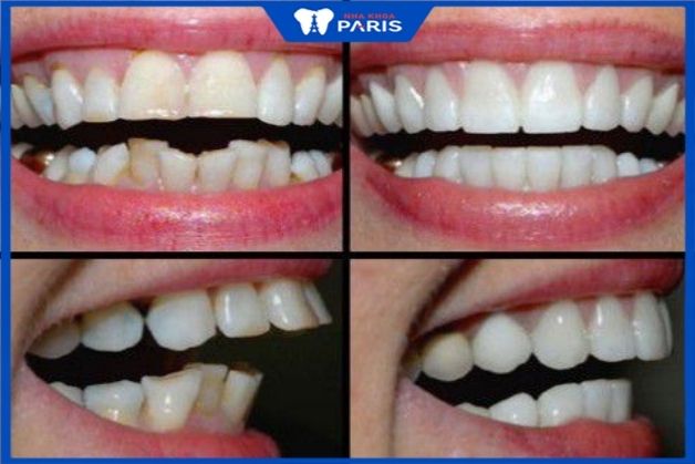 Độ chìa của răng trước và sau khi bọc sứ bọc răng sứ chỉnh hô
