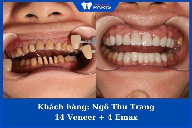 Khách hàng trước và sau bọc răng sứ tại nha khoa Paris Bọc răng sứ veneer 