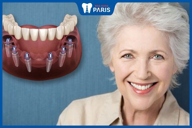 Lý do nền trồng răng Implant cho người già