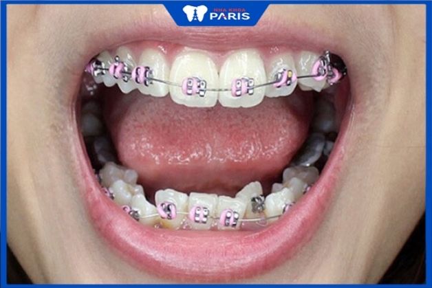 Niềng răng truyền thống điều trị được cả các tình trạng răng nặng