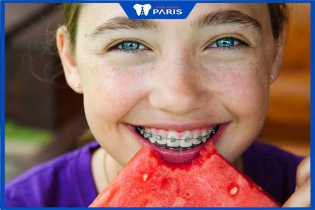 Niềng răng mắc cài kim loại hệ tự đóng có thể ăn uống thoải mái hơn