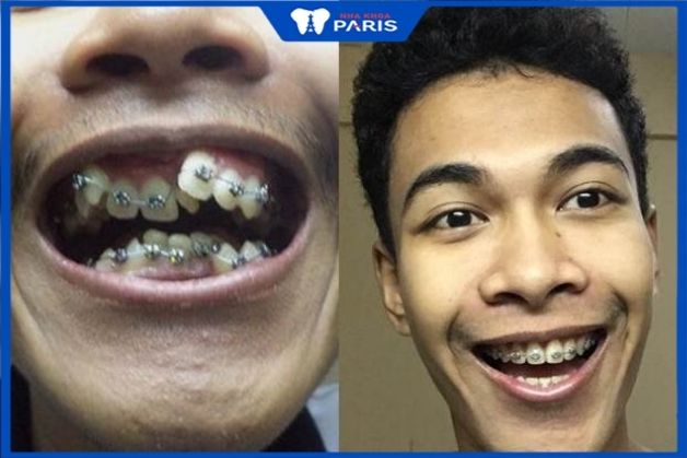 Trước và sau niềng răng kim loại hệ tự đóng