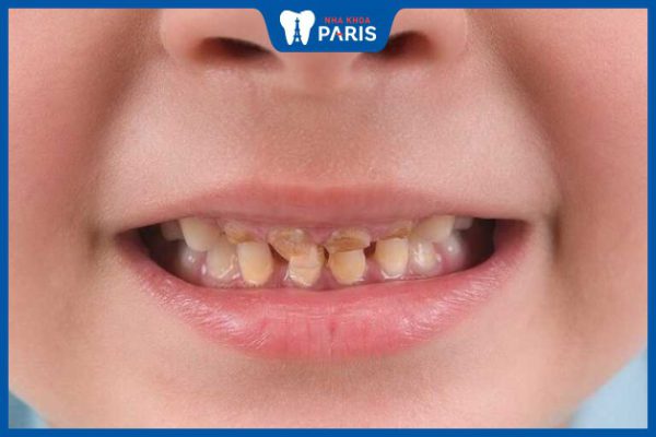 Răng bé bị vàng: Những nguyên nhân chính gây ra răng bị vàng