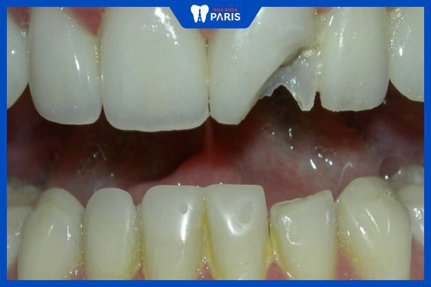 Răng sứ kém chất lượng dễ bị vỡ