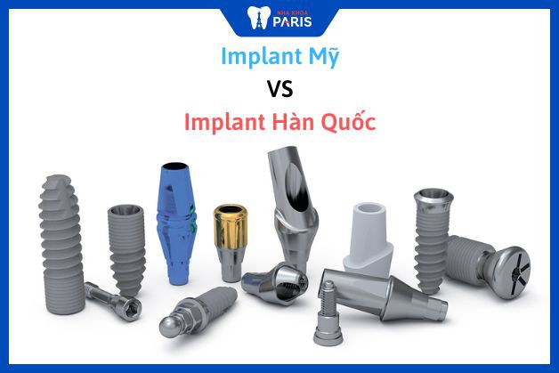 So sánh Implant Mỹ vs Implant Hàn Quốc