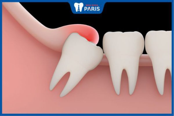 Các kiểu răng khôn mọc lệch và cách nhổ bỏ an toàn, ít sưng đau
