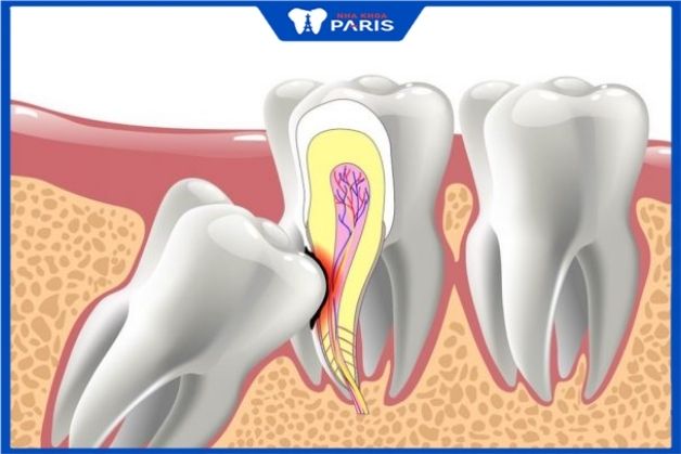 Nhổ răng khôn sớm để ngăn ngừa biến chứng cho răng bên cạnh
