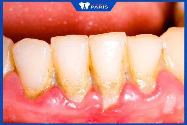 Mảng bám ở cổ răng là cao răng
