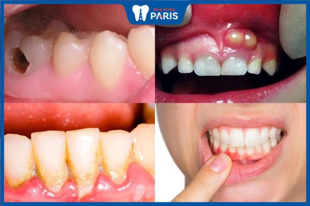 Niềng răng giảm khả năng mắc một số bệnh lý