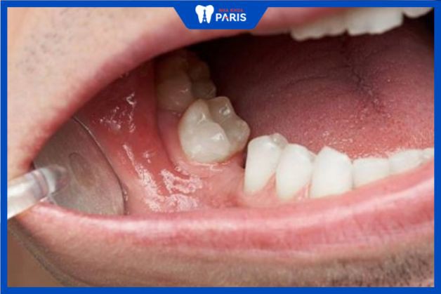 Khoảng trống mất răng ảnh hưởng nhiều tới hàm và nướu