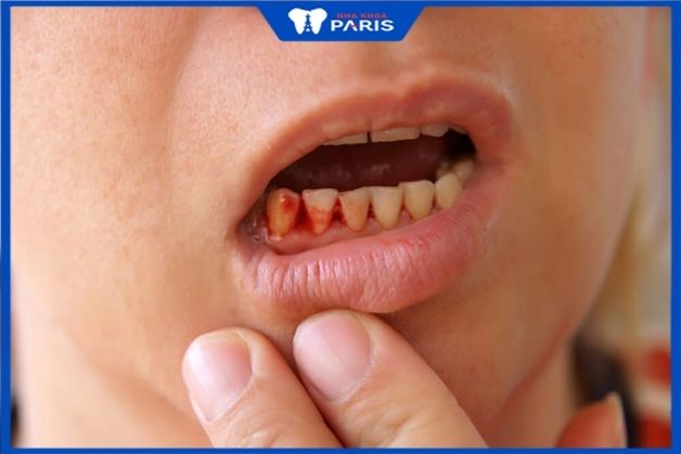Chảy máu nướu kéo dài khi trồng răng
