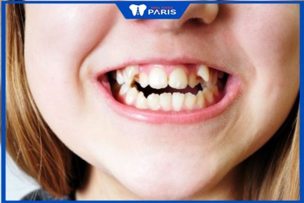 niềng răng cho trẻ 6 tuổi