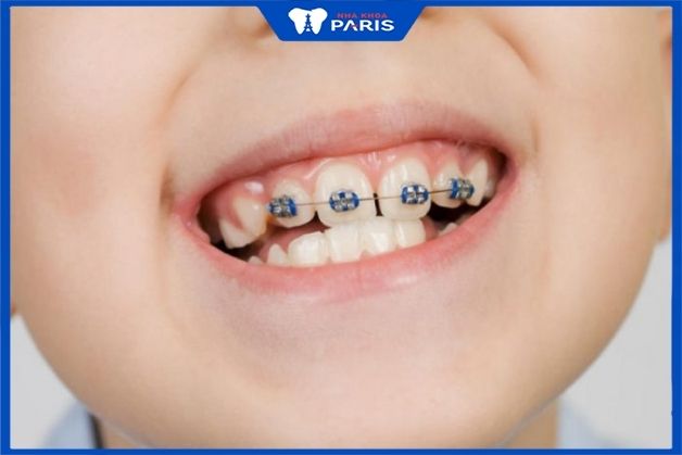 niềng răng cho trẻ 6 tuổi