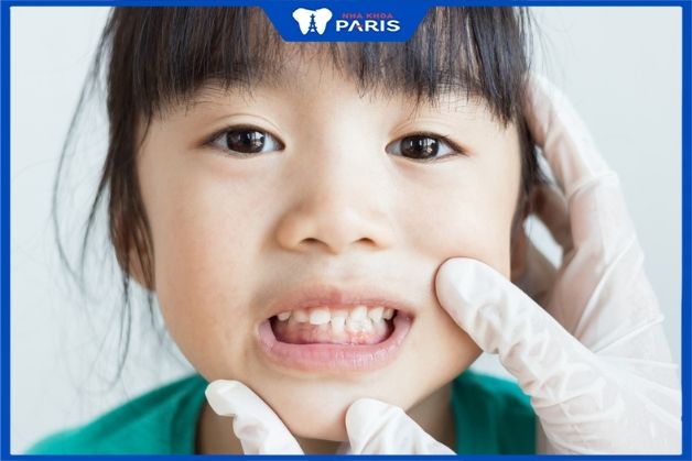niềng răng cho trẻ 6 tuổi