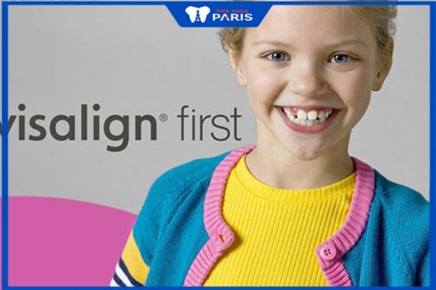 niềng răng cho trẻ 6 tuổi