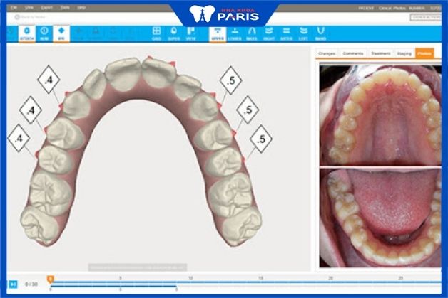 niềng răng invisalign ở hà nội
