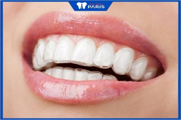 niềng răng invisalign ở hà nội