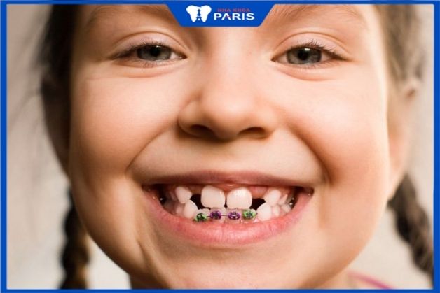 Trẻ em niềng răng bị thưa nhanh hơn người lớn