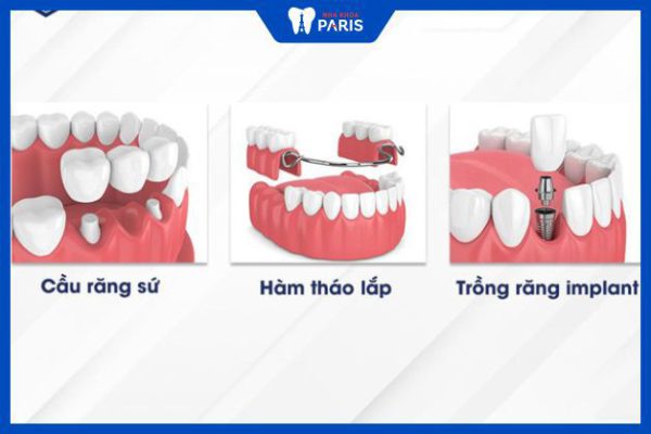 Trồng răng giả – Lợi ích, chi phí và các phương pháp thực hiện