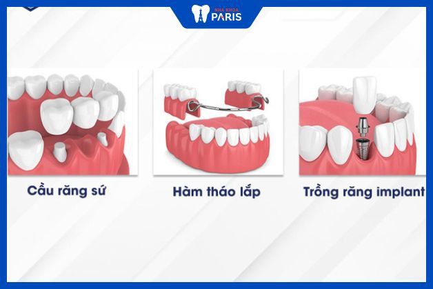 Trồng răng giả – Lợi ích, chi phí và các phương pháp thực hiện