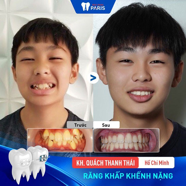 Giai đoạn 10-12 tuổi niềng răng cho trẻ rất phức tạp