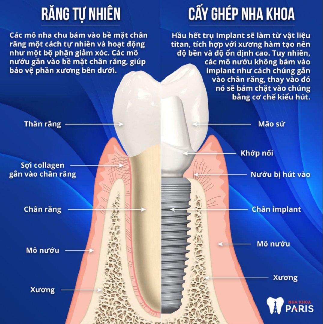So sánh răng thật và răng implant