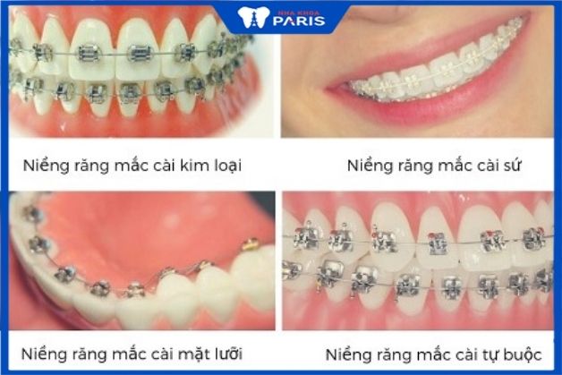 Niềng răng bằng chất liệu kim loại dễ bị lộ mắc cài khi giao tiếp