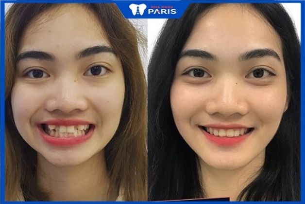 Khách hàng Nguyễn Phương Thúy: trước và sau niềng răng thưa khấp khểnh tại Paris