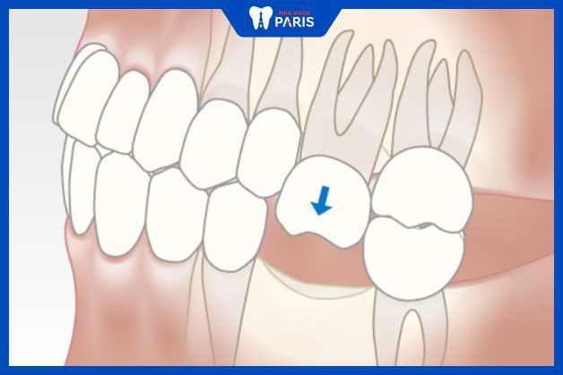 Hàm răng cần có trụ Implant bảo vệ