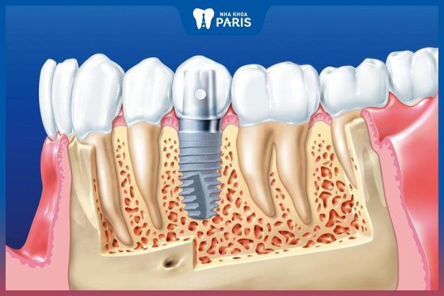 Các yếu tố ảnh hưởng đến mức độ đau sau khi trồng răng Implant