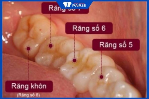Răng khôn số 8 - chiếc răng thứ 8 được tính từ răng cửa