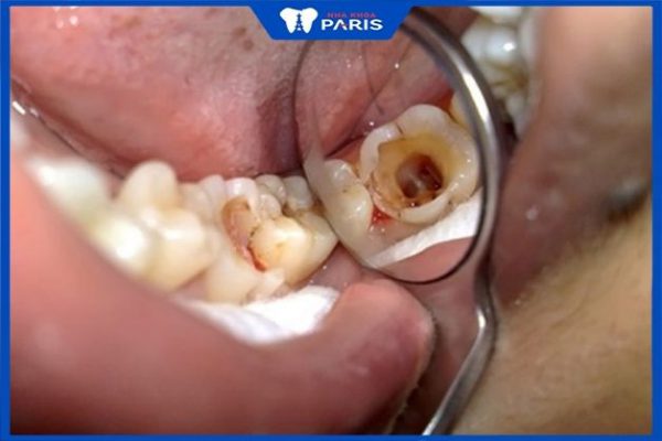 Răng khôn số 8 gây tình trạng sâu răng
