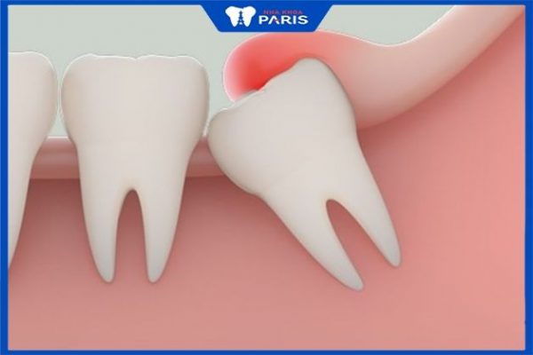 Việc nhổ răng khôn số 8 dựa vào tư vấn và thăm khám của các bác sĩ