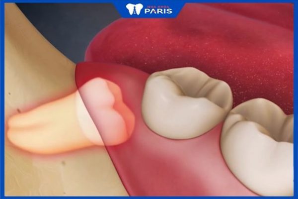 Răng khôn có thể gây ra các biến chứng nguy hiểm