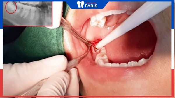 Nhổ răng khôn số 8 có ảnh hưởng gì đến hàm không?