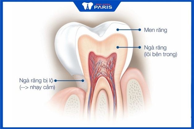 Ngà răng bị lộ ra ngoài gây nên tình trạng ê buốt