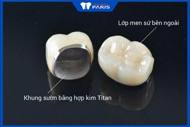 Răng sứ titan có cấu tạo gồm hợp kim titan và men sứ bọc răng sứ titan