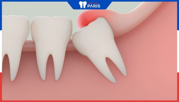 Top 12 cách giảm đau khi mọc răng khôn bạn nên biết