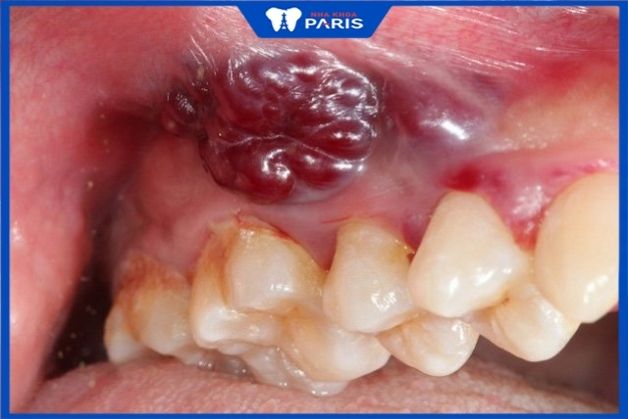 Áp xe nướu do vi khuẩn từ răng khôn gây ra 