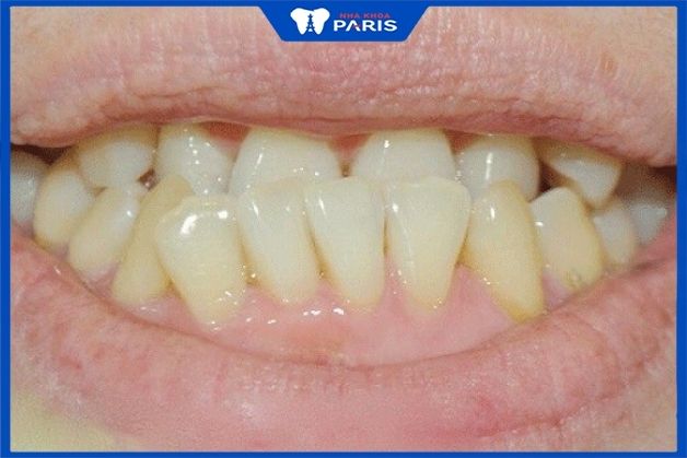 Những người răng mọc không đều nên tiến hành chỉnh nha