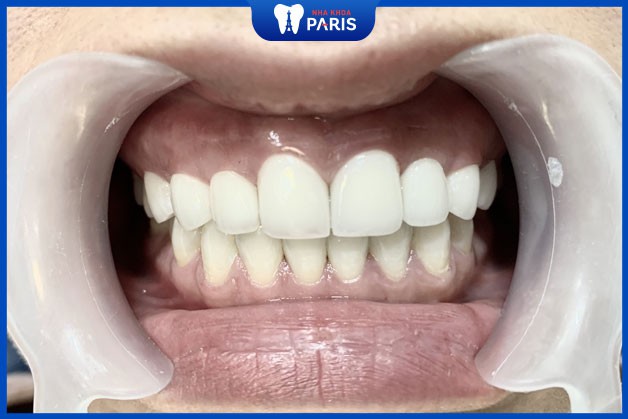 Răng sứ cần đảm bảo chế tác chất lượng cao