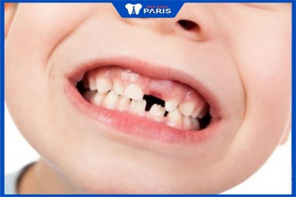 6 tuổi – 12 tuổi (thay răng vĩnh viễn) nên niềng răng cho trẻ khi nào