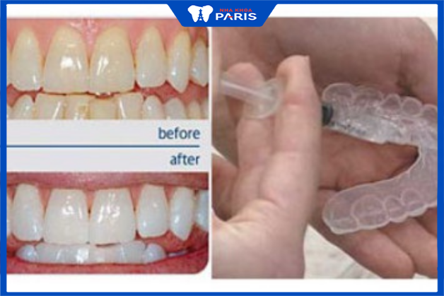Thuốc tẩy trắng răng được thực hiện tại nhà