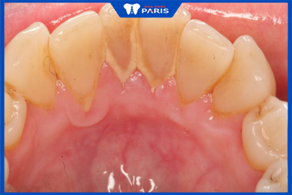 Răng bị đóng vôi: Nguyên nhân và cách điều trị vôi răng