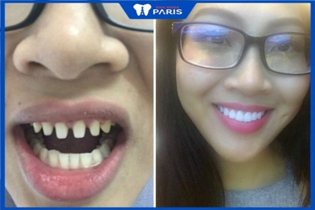 Trước và sau bọc răng sứ thẩm mỹ